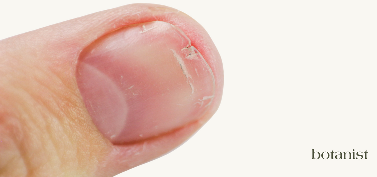 Split Nail Back Fixing Split Nails: Easy Remedies and Everyday Prevention – botanist